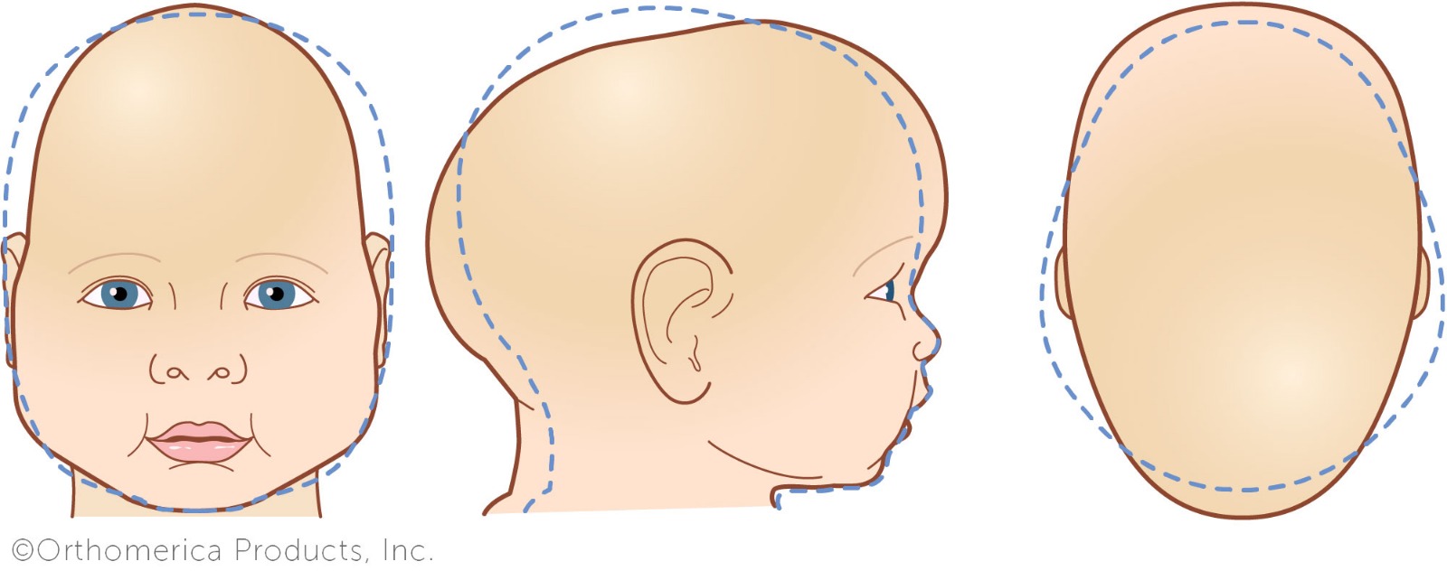 Sagital sutr sinostoz (sagittal suture synostosis) en ok rastlanan tek sutr (kapal) sinostoz tipidir ve arlkl olarak erkek yeni doanlar etkilemektedir. 