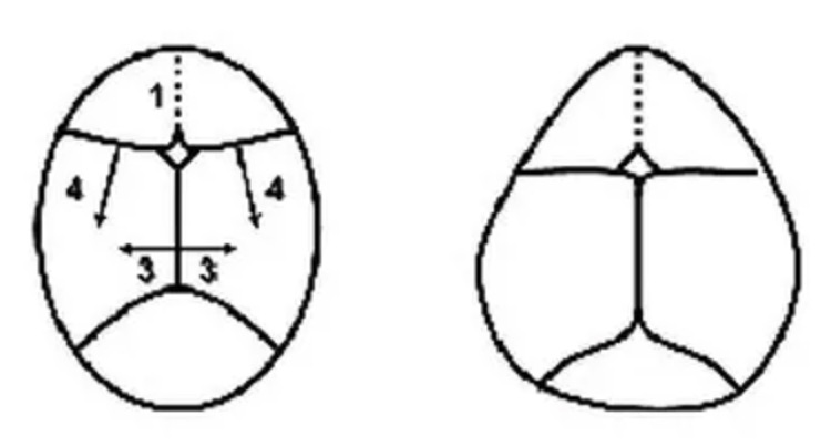 Koronal str sinostoz dier adyla anterior plagiosefali ve metopik str sinostoz dier adyla trigonosefali, grsel olarak kendisini ok fazlasyla belli eden iki kraniosinostoz tipidir.