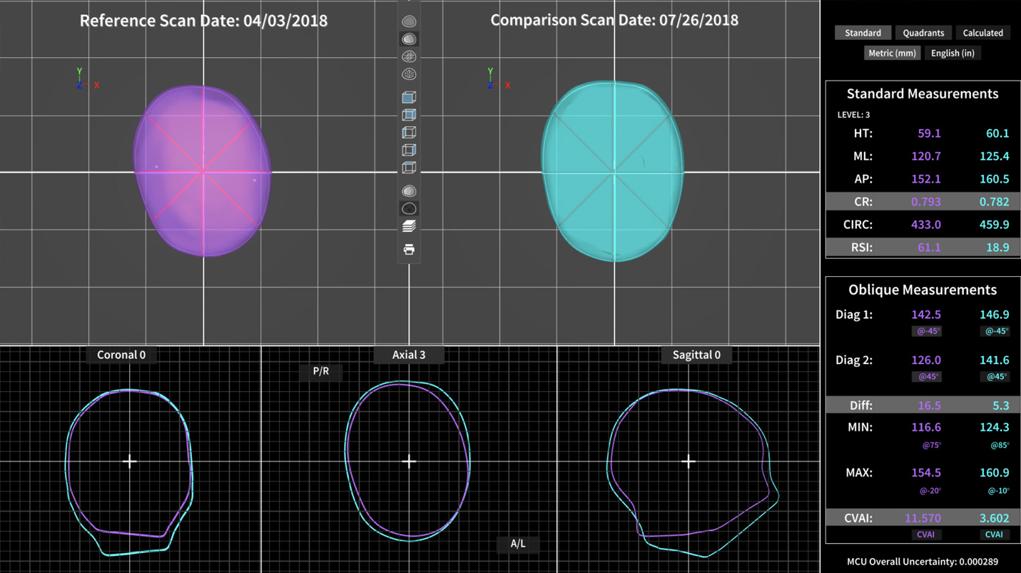 STARscanner 3D kafatas tarama, SmartSoc 3D kafa  tarama, STARband kask tedavisi program, Kask tedavisi, Bebeklerde kask tedavisi, orthomerica, starband kask tedavisi, kafa kask tedavisi, kraniyal ortez kask, kafatas 3D l, Grsel kafatas deerlendirme, STARband ortez teknikeri, grsel kafa deerlendirmesi, bebek kafatas tarama, bebek kafatas ls