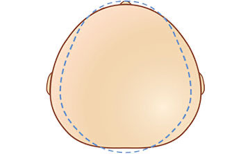 deformasyonel brakisefali