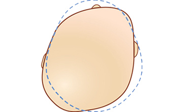 deformasyonel plagiosefali