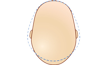 deformasyonel skafosefali